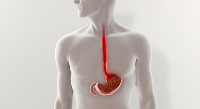 Gastroösophageale Refluxkrankheit (GERD)