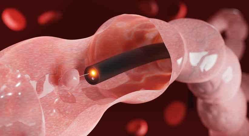 Endoskopische Mukosaresektion (EMR)  - OA Dr. Lukas Wagner - Gastroenterologe u. Hepatologe Wien 1190