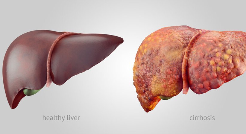 Leberzirrhose - OA Dr. Lukas Wagner - Gastroenterologe u. Hepatologe Wien 1190