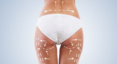 Fettabsaugung (Liposuktion)