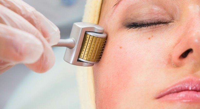 Microneedling mit Radiofrequenz - Dr. med univ. Christian Wolf, Executive MBA - Plastischer Chirurg Wien 1060