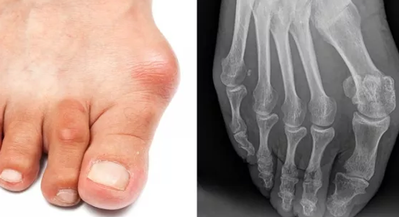 Fußchirurgie - OA Dr. Clemens Hüthmair - Orthopäde Wien 1050