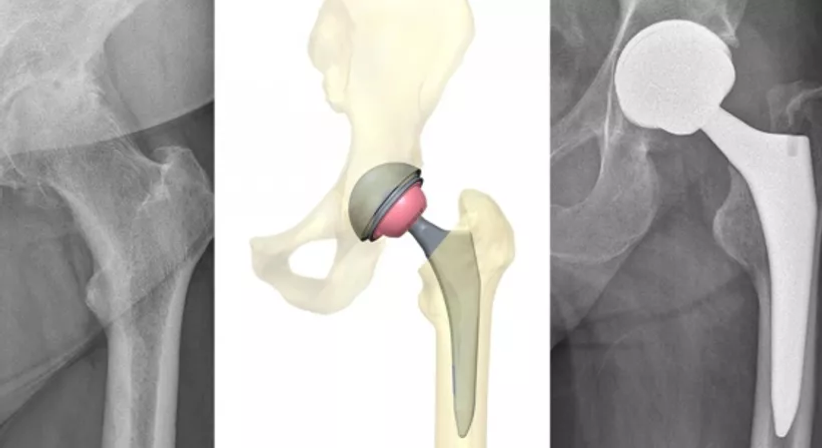 Hüftprothese - OA Dr. Clemens Hüthmair - Orthopäde Wien 1050