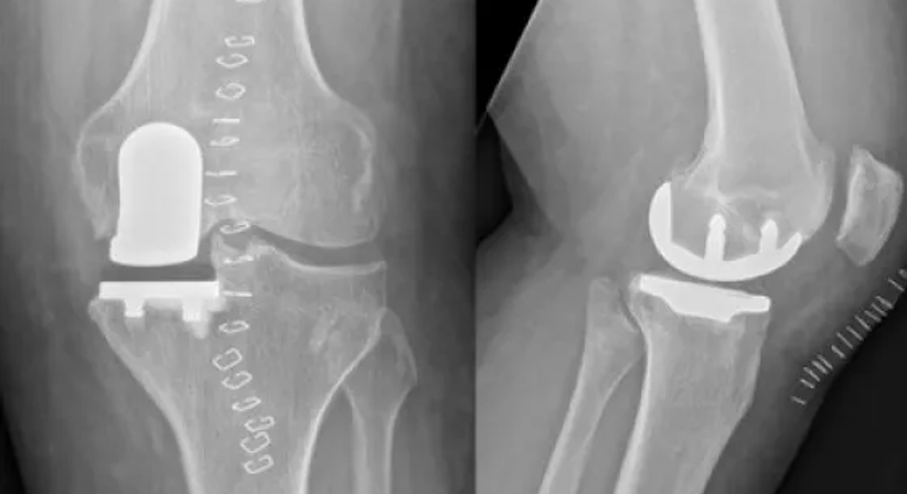 Knieprothese - OA Dr. Clemens Hüthmair - Orthopäde Wien 1050