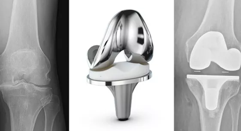 Knieprothese - OA Dr. Clemens Hüthmair - Orthopäde Wien 1050