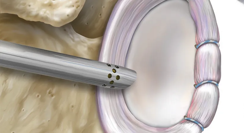 Arthroskopische Schulterstabilisierung - OA Dr. Markus Riedl - Orthopäde Wien 1190