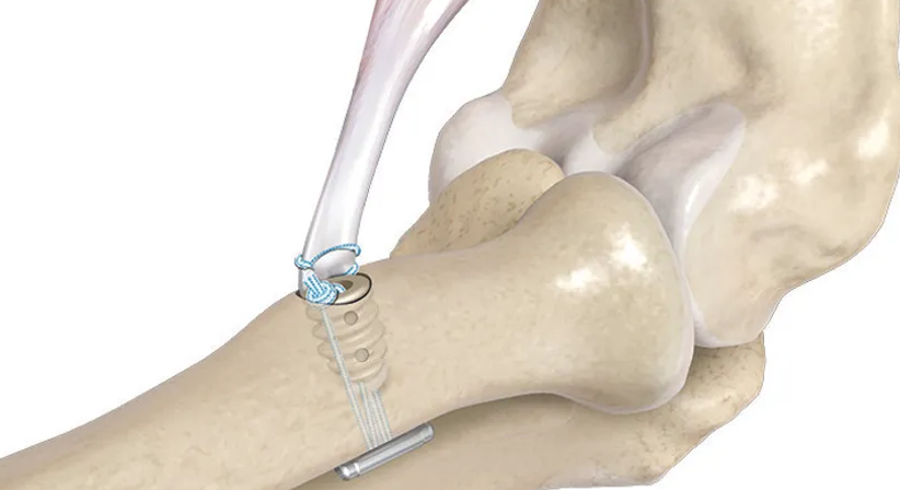 Distale Bizepssehnenruptur - OA Dr. Markus Riedl - Orthopäde Wien 1190