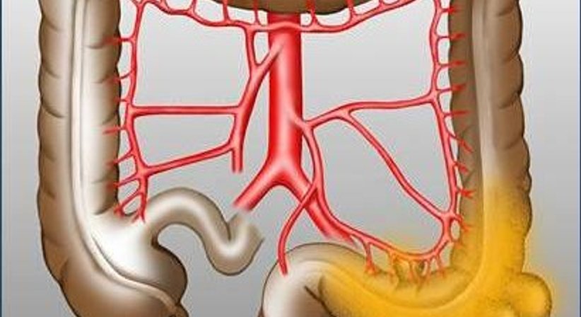 Operationen des Dünn- und Dickdarms - Priv. Doz. Dr. Ruxandra Ciovica - Allgemeinchirurgin/Viszeralchirurgin Wien 1010