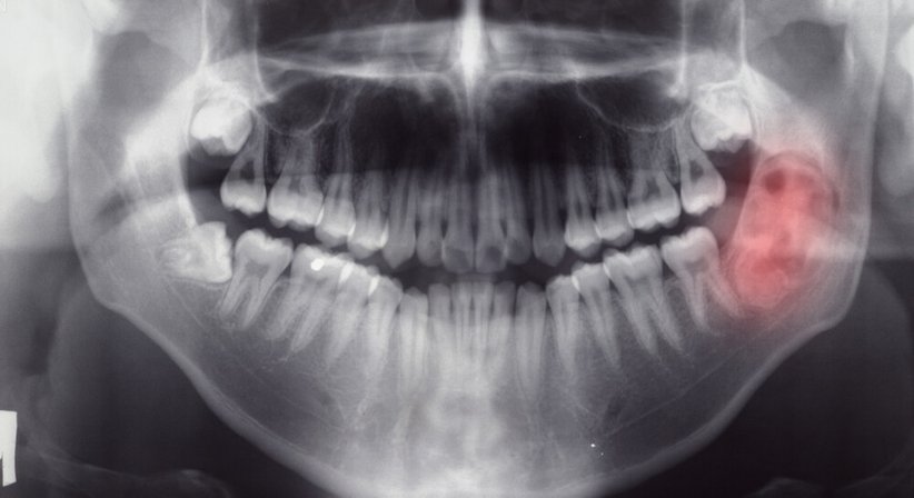 Tumorvorsorge - Dr. Stefan Edlinger - HNO-Arzt Wien 1040