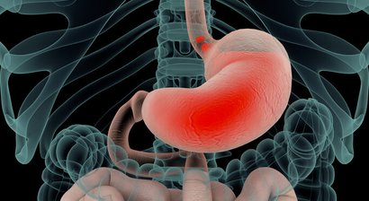 Magenerkrankungen: Gastritis, Reflux, Zwerchfellbruch/Hiatushernie