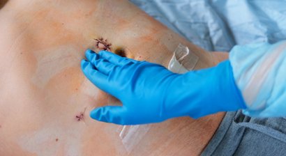 Bauchwandbrüche: Leistenbruch, Nabelbruch, Narbenbruch