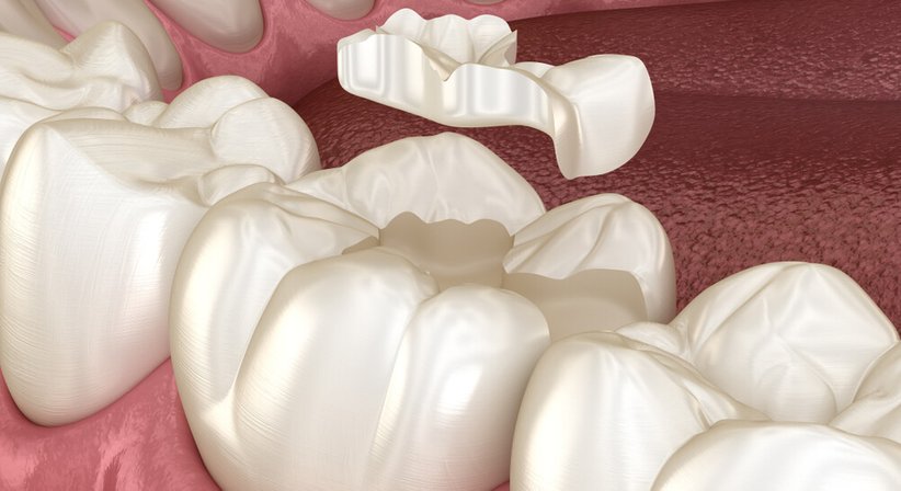 Inlays - Dr. med. dent. Silke Spanlang, MSc - Zahnärztin Wien 1010