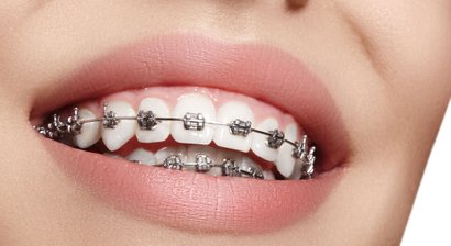 Kieferorthopädie inklusive Zahnspange