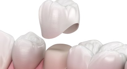 Zahnkronen, Zahnfüllungen und Wurzelbehandlungen