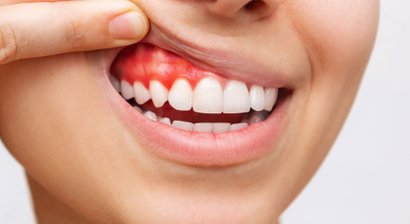 Zahnfleischschwund- und Zahnbettentzündungsbehandlungen