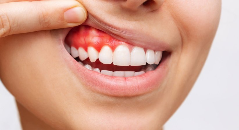 Zahnfleischschwund- und Zahnbettentzündungsbehandlungen - Zahn-, Mund-, Kieferheilkunde -  Wien 1090