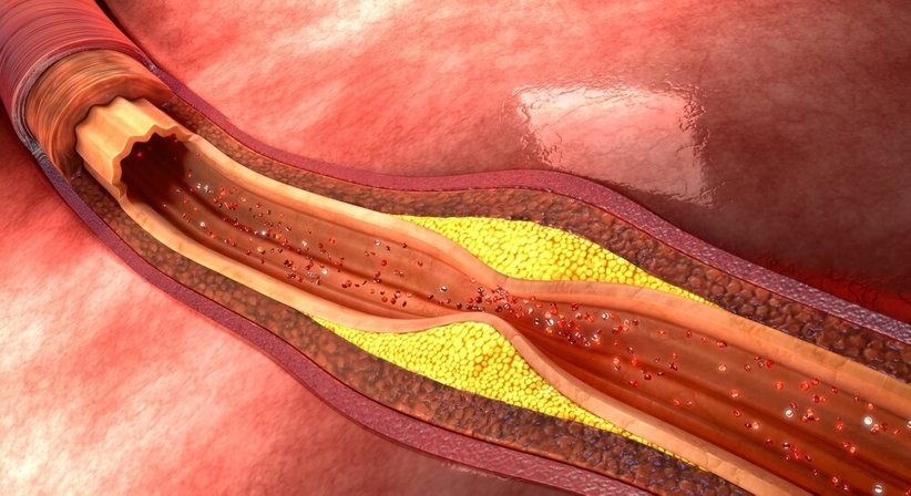 Arteriosklerose - Prim.Doz. Dr. Afshin Assadian - Gefäßchirurg Wien 1190