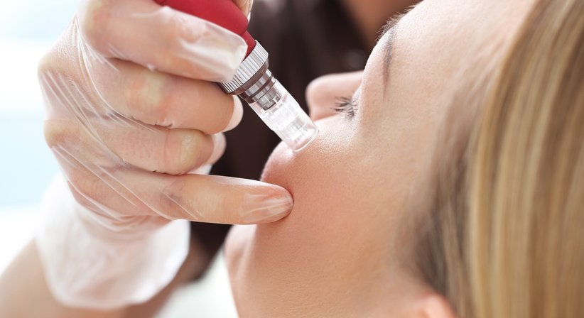 Microneedling - Dr. Thomas Giesler - Plastischer Chirurg Kitzbühel 6370