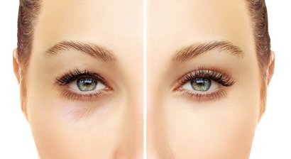 Lidkorrektur - Ober- und Unterlidstraffung