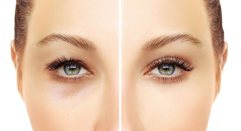 Lidkorrektur - Ober- und Unterlidstraffung - Dr. Thomas Giesler - Plastischer Chirurg Kitzbühel 6370