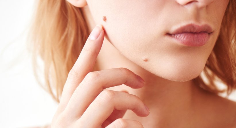 Chirurgische Entfernung von Hauttumoren / Lappenplastik - Dr. Thomas Giesler - Plastischer Chirurg Kitzbühel 6370