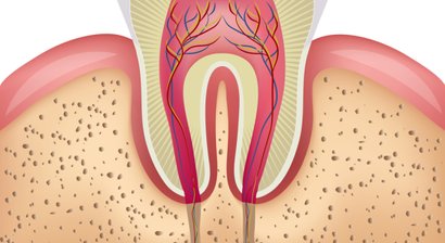 Wurzelspitzenresektion