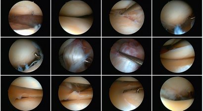 Arthrosetherapie mit Hyaluronsäure