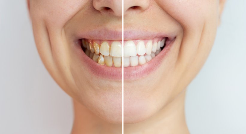 Bleaching - Dr. Raluca-Iulia Mamut-Zahradnik - Zahnärztin Wien 1120