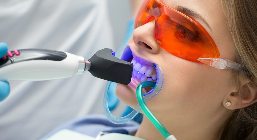 Bleaching - Ing. Dr. Gernot Blabensteiner - Zahnarzt Schweiggers 3931