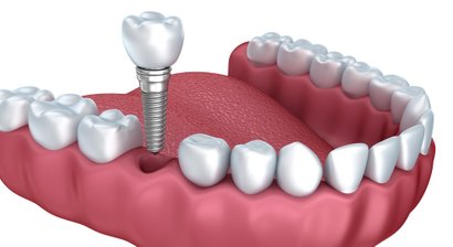 Implantate / Knochenaufbauten