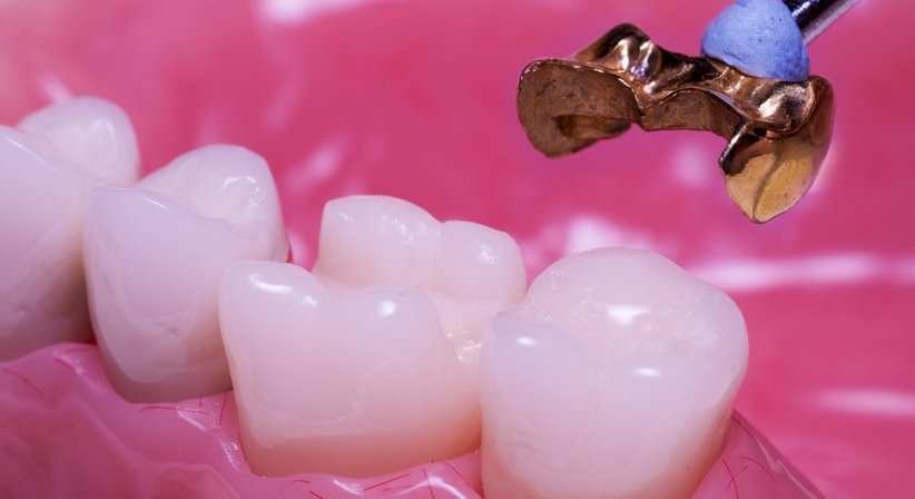 Kronen / Brücken - Ing. Dr. Gernot Blabensteiner - Zahnarzt Schweiggers 3931