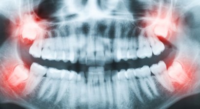 Weisheitszahnentfernung