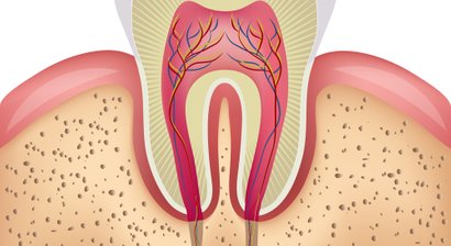 Wurzelspitzenresektion