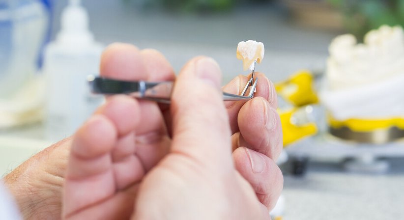 Keramische Versorgungen - Dr. Klemens Steffan, MDSc. - Zahnarzt Baden 2500