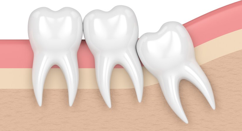 Oralchirurgie - Dr. Klemens Steffan, MDSc. - Zahnarzt Baden 2500