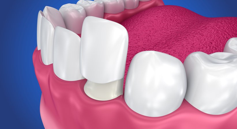 Veneers, Lumineers - Dr. Wjaczeslaw Pinchasov - Zahnarzt Wien 1140