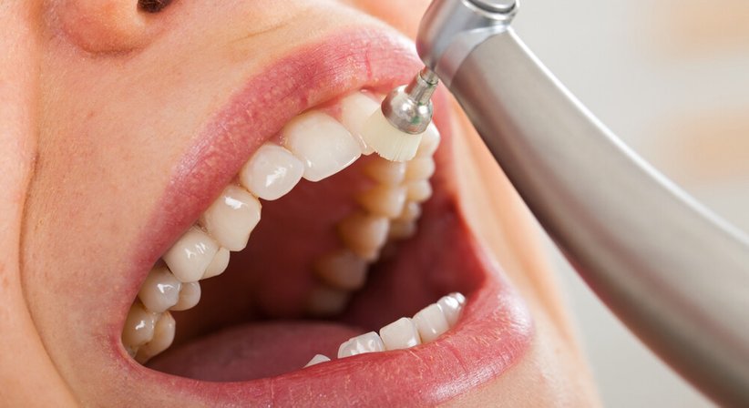 Professionelle Mundhygiene - Dr. Wjaczeslaw Pinchasov - Zahnarzt Wien 1140