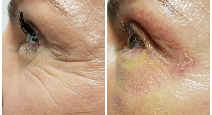 Plasmage (Lidstraffung ohne OP) - Dr. med. univ. Mag. art. Hanna Sheu, MPH - Allgemeinchirurgin Linz 4020