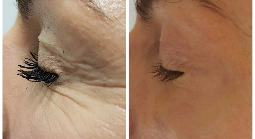 Plasmage (Lidstraffung ohne OP) - Dr. med. univ. Mag. art. Hanna Sheu, MPH - Allgemeinchirurgin Linz 4020