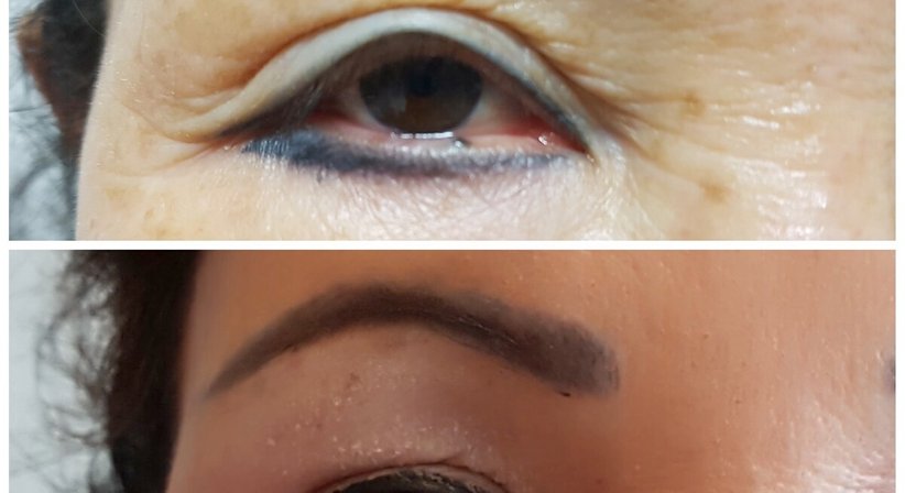 Plasmage (Lidstraffung ohne OP) - Dr. med. univ. Mag. art. Hanna Sheu, MPH - Allgemeinchirurgin Linz 4020