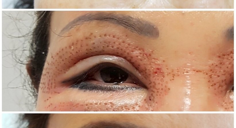 Plasmage (Lidstraffung ohne OP) - Dr. med. univ. Mag. art. Hanna Sheu, MPH - Allgemeinchirurgin Linz 4020