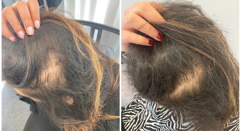 PRP - Haarwuchstherapie (Vampirlifting) - Dr. med. univ. Mag. art. Hanna Sheu, MPH - Allgemeinchirurgin Linz 4020