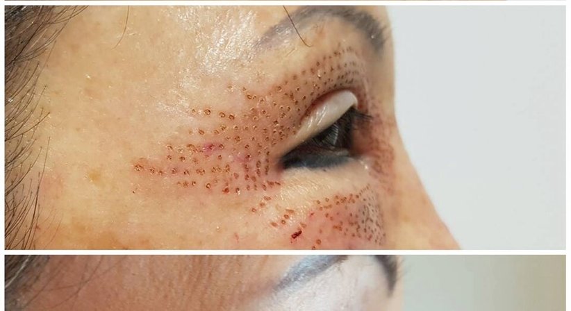 Plasmage (Lidstraffung ohne OP) - Dr. med. univ. Mag. art. Hanna Sheu, MPH - Allgemeinchirurgin Linz 4020