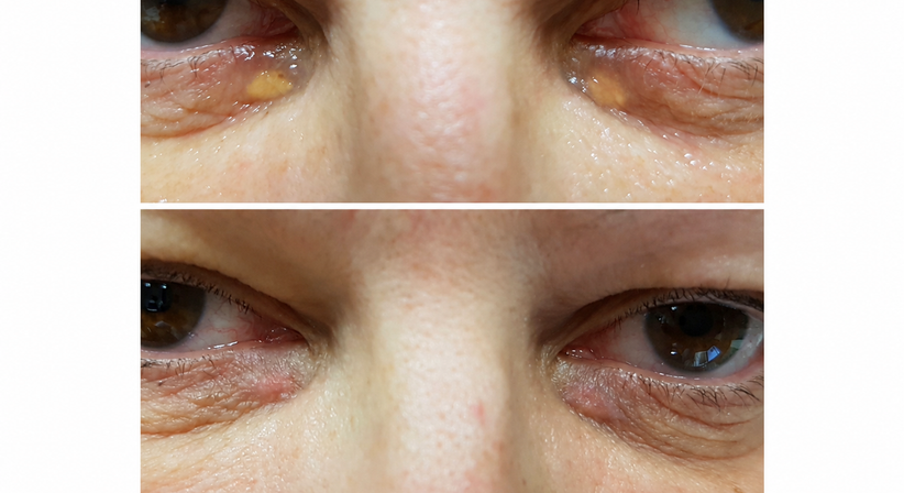 Entfernung von Muttermalen und Hautveränderungen – operativ oder mit Plasmage® bei Dr. med. univ. Mag. art. Hanna Sheu, MPH
