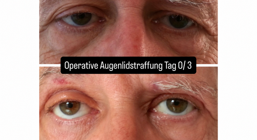 Oberlidstraffung (Blepharoplastik) bei Dr. med. univ. Mag. art. Hanna Sheu, MPH