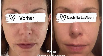 Aknetherapie (multimodales Konzept)