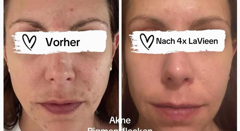 Aknetherapie (multimodales Konzept) bei Dr. med. univ. Mag. art. Hanna Sheu, MPH