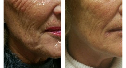 Venus Versa® (Kombinationsbehandlung für das Gesicht)