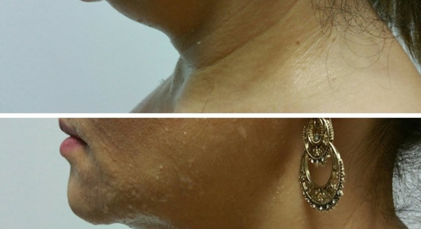 Fettwegspritze (Intralipotherapie) - Dr. med. univ. Mag. art. Hanna Sheu, MPH - Allgemeinchirurgin Linz 4020