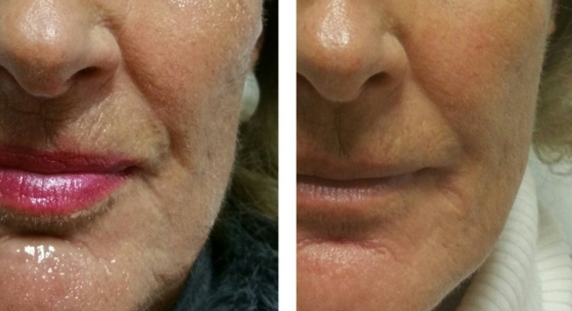 Hyaluronsäure (Filler) - Dr. med. univ. Mag. art. Hanna Sheu, MPH - Allgemeinchirurgin Linz 4020